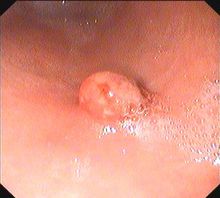 胃神经官能症(图5) 胃神经官能症(图5)