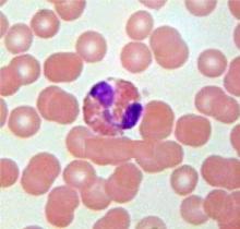 嗜酸粒细胞病理图 嗜酸粒细胞病理图