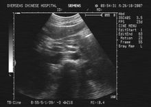 硬化性胆管炎 硬化性胆管炎